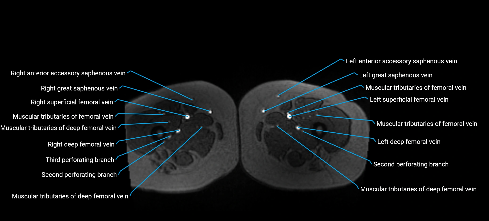 MRV abdomen pelvis & lower limb axial cross sectional anatomy labelled MRI image 238 (1).webp